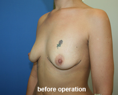 plastic-surgery-breast-augmentation